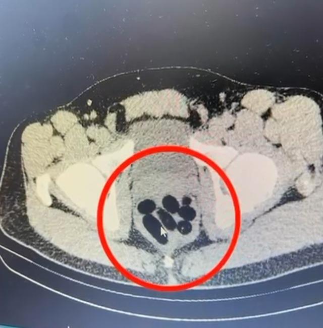 Uluslararası uyuşturucu kaçakçılığına karışan şüpheli midesinde uyuşturucuyla yakalandı2